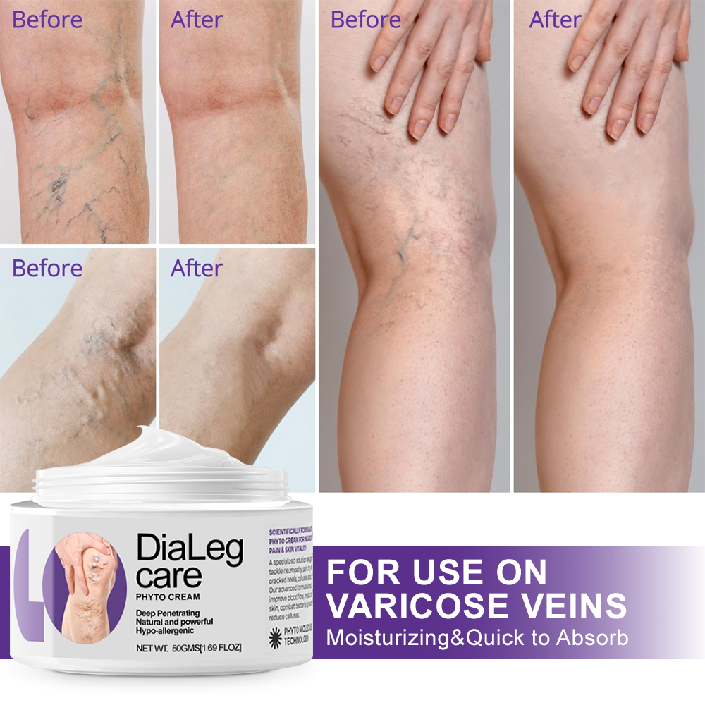 🏆✅𝐍𝐇𝐒-𝐀𝐏𝐏𝐑𝐎𝐕𝐄𝐃 - ODEIUN™𝐃𝐢𝐚𝐋𝐞𝐠 𝐂𝐚𝐫𝐞 𝐏𝐡𝐲𝐭𝐨 𝐂𝐫𝐞𝐚𝐦 - Helps Treat Varicose Veins, Swelling, Cramps, and Leg Pain